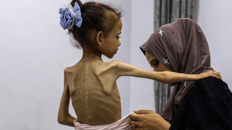 أطفال غزة يحتضرون ببطيء جراء الجوع