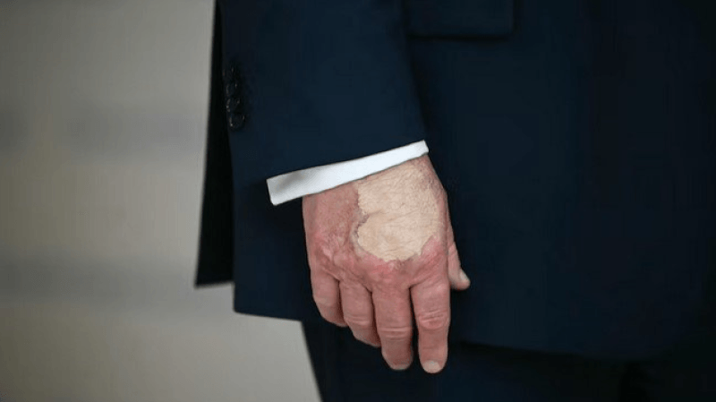 Donald Trump : sa main maquillée relance les rumeurs sur sa santé