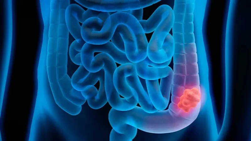 حملة صحية مجانية للتقصي المبكر لسرطان القولون بباردو..التفاصيل