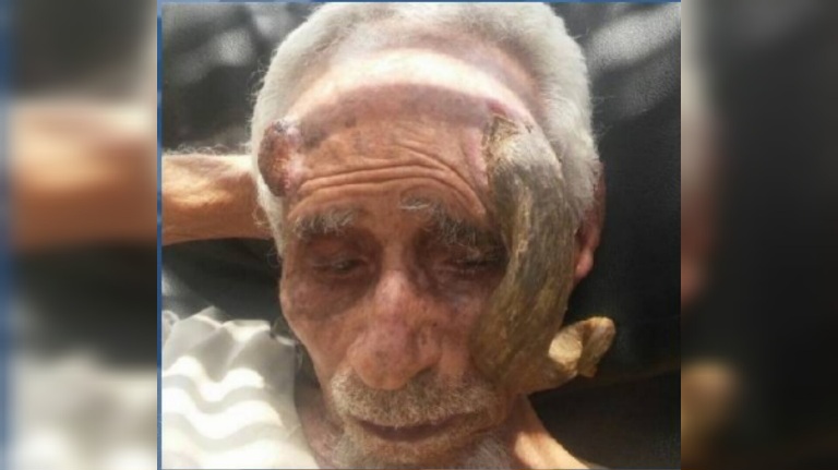 بعد بتر قرنيه دون جراحة.. وفاة اليمني “ذو القرنين” عن عمر 140 سنة