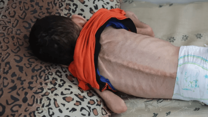 بسبب المجاعة والجفاف.. استشهاد طفلة في غزة