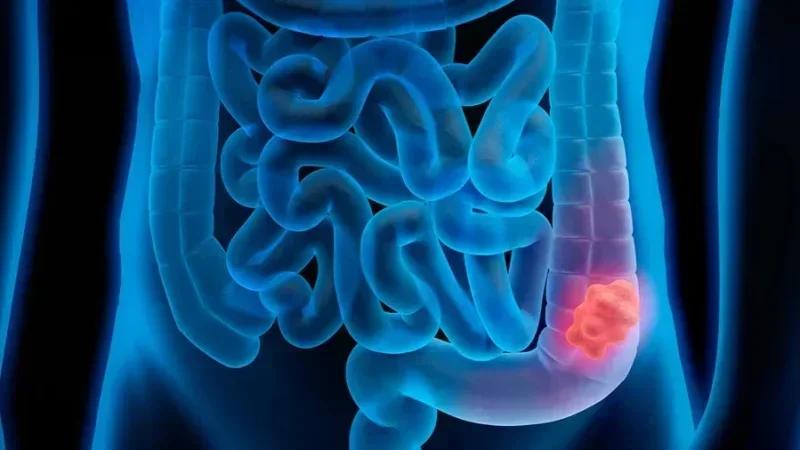 Le Bardo: Campagne gratuite de dépistage du cancer du côlon