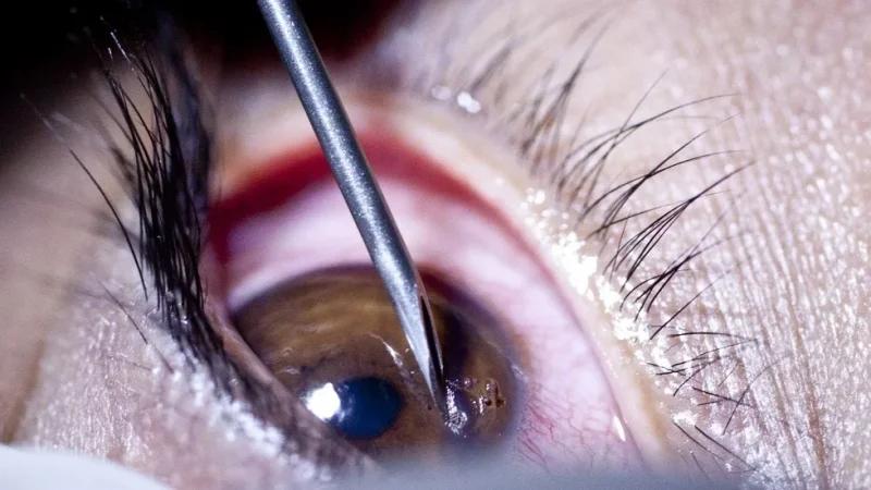 نجاح ثاني عملية زرع قرنية بالمستشفى الجهوي بالقصرين