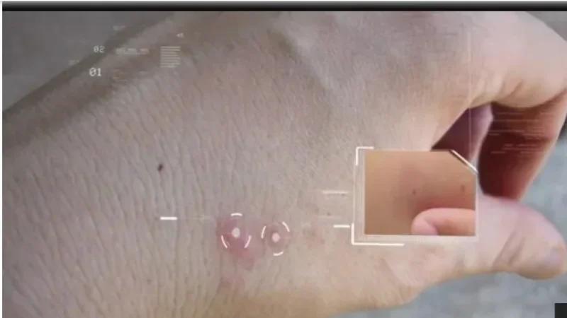 القصرين: حوالي 30 إصابة باللاشمانيا في النصف الأول من جانفي