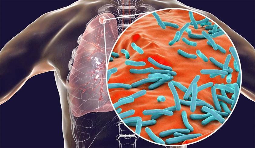 Hausse des cas de tuberculose ' Les autorités démentent les rumeurs