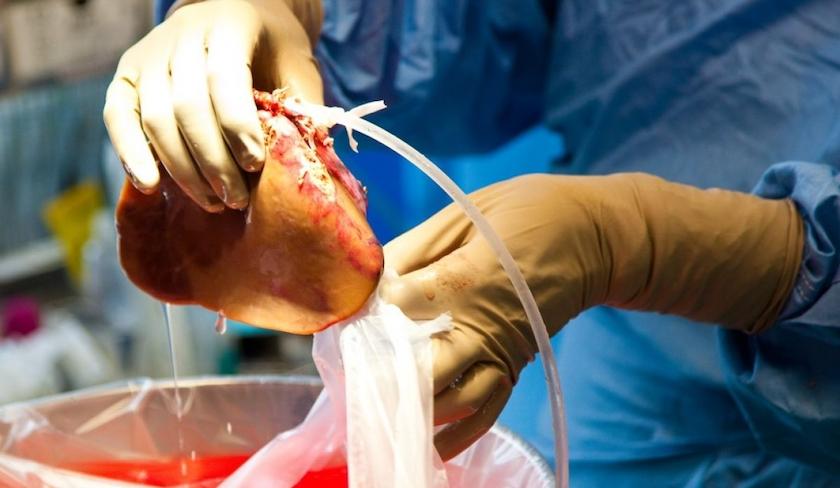 Le DG du Centre national de la transplantation d'organes dément l'existence d'un trafic en Tunisie