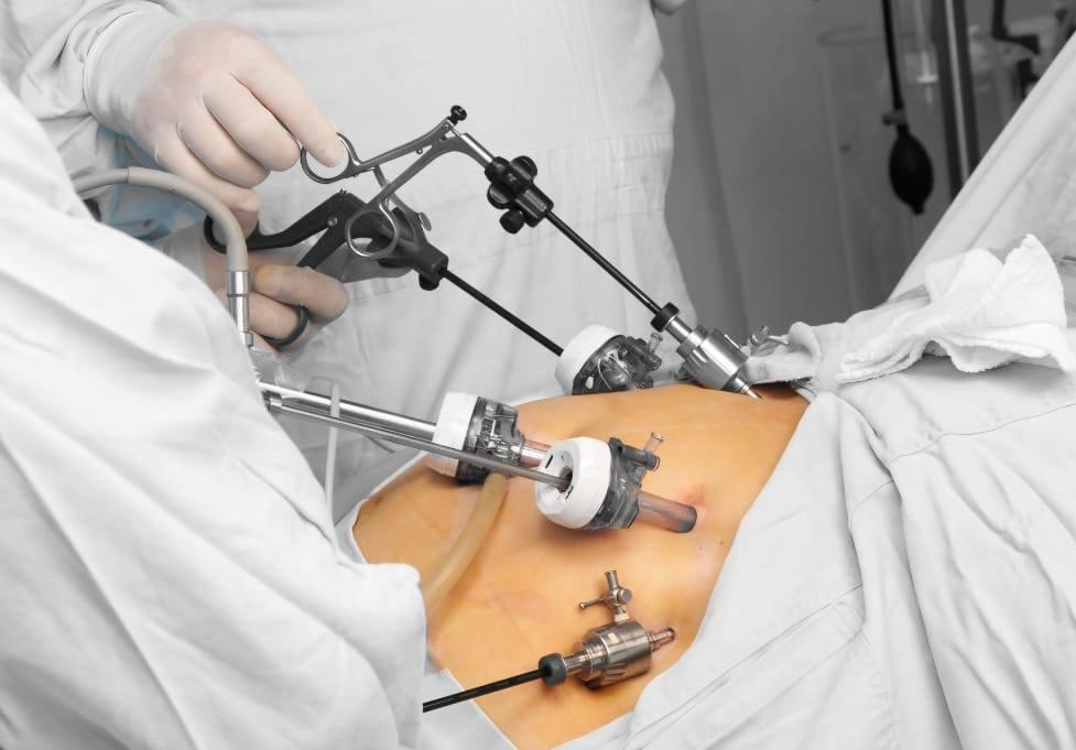 Tataouine : Réussite d’une première opération de résection tumorale de l’estomac par laparoscopie, Une avancée...